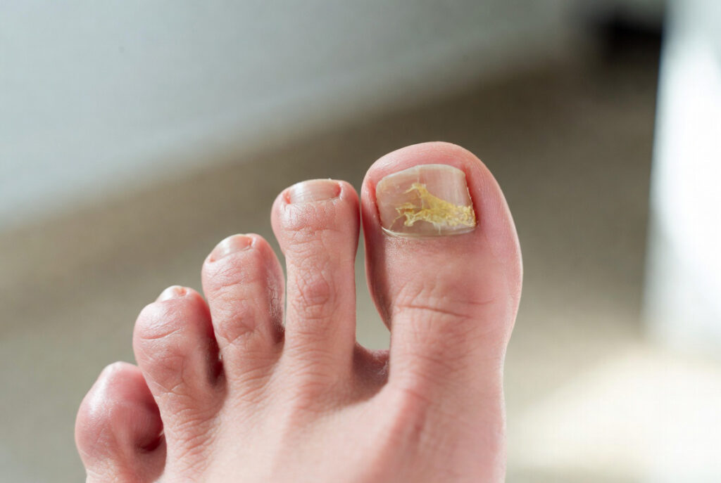 Nagelpilz